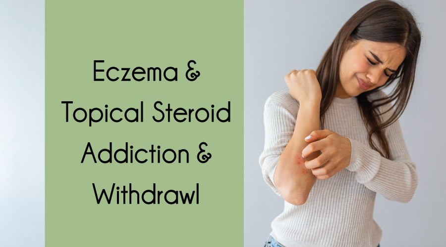 Eczema & Topical Steroid Addiction & Withdrawl Dr. Anna Medical
