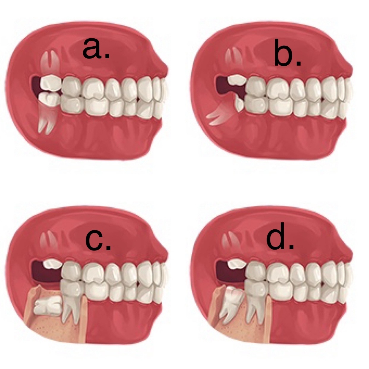 Do wisdom teeth have to be removed? Dr Anna Murphy