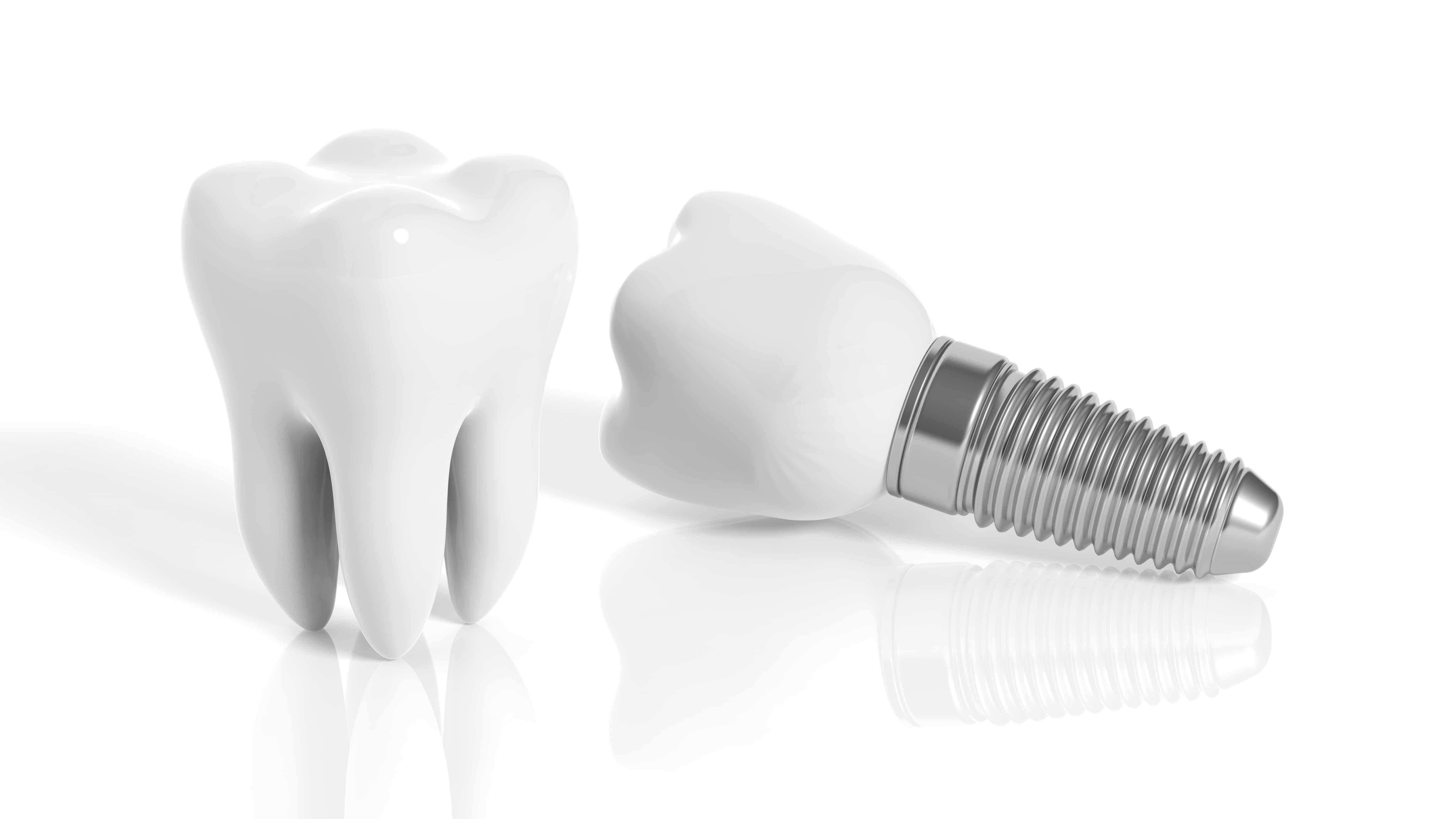 What Does Placing Dental Implants Involve? Encinitas, CA