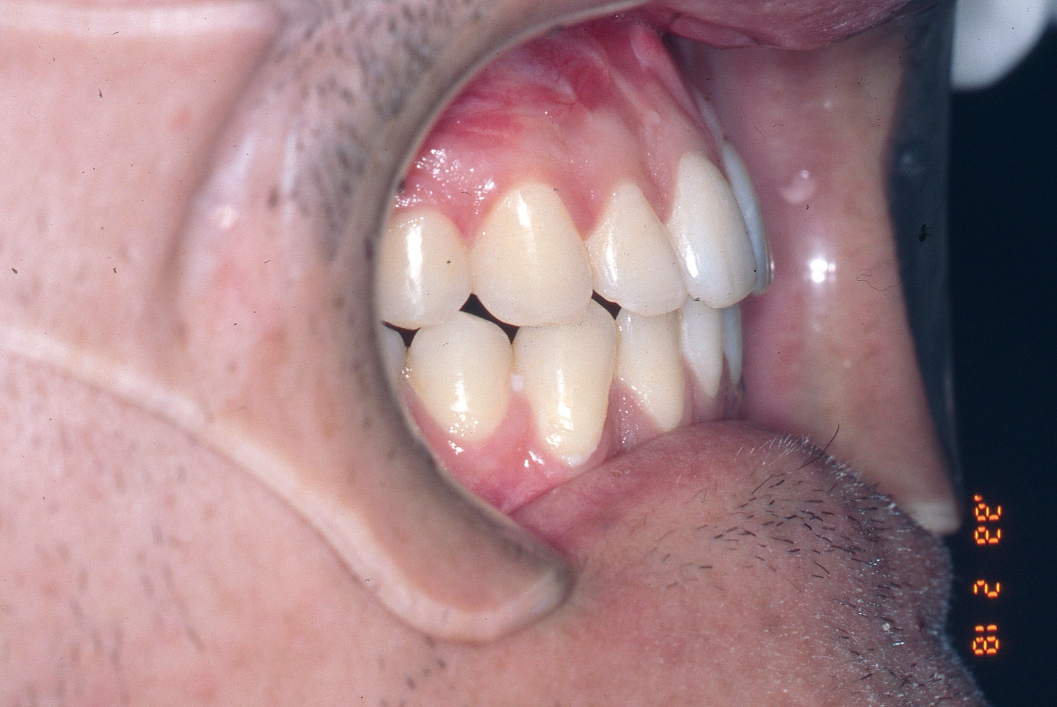 Orthognathic Surgery Dr. Anthony J. Oliver Oral Surgeon