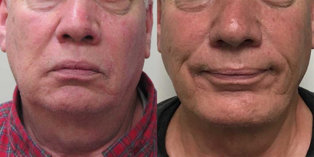Facial Implants Before and After Photos