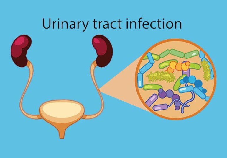 Urinary Tract Infection Dr Aroon Trivedi