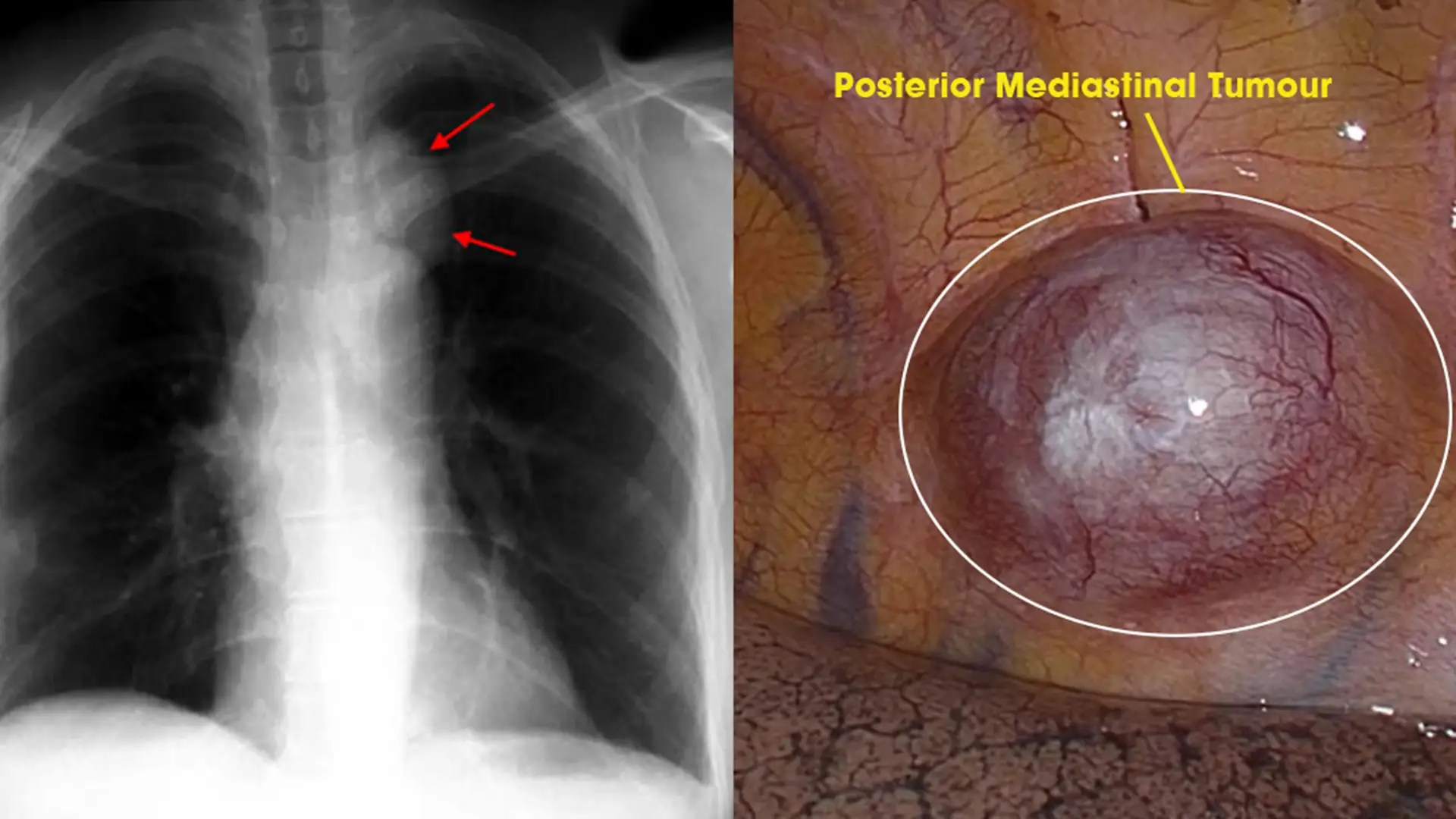 Best Robotic Thymectomy Surgery in Delhi India Dr. (Prof.) Arvind Kumar