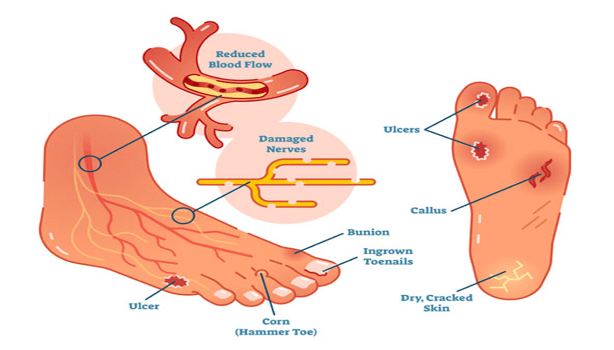 Diabetic Foot Doctor in Lucknow Dr. Ashutosh