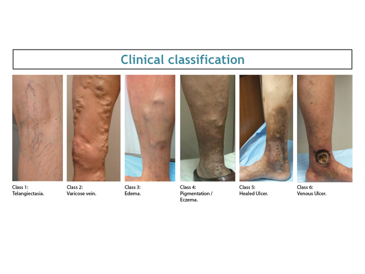 Classification Of Varicose Veins Dr. Avinash Katara Minimal Access