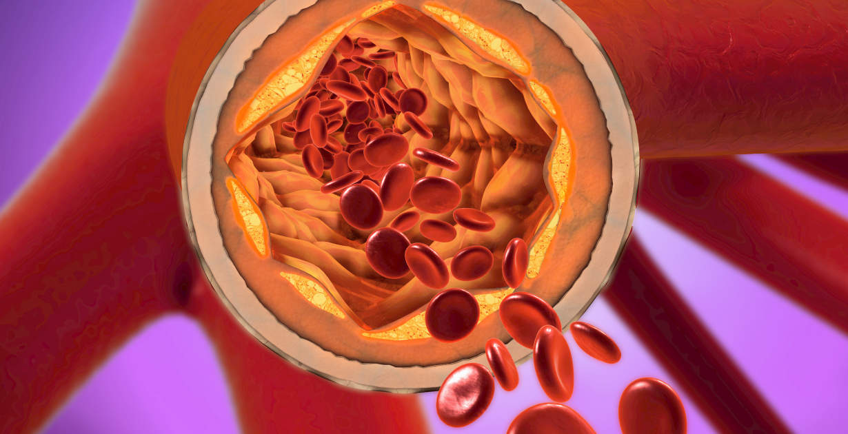 Arteriosclerosis Eat More (Good) Fat & Fiber to Prevent