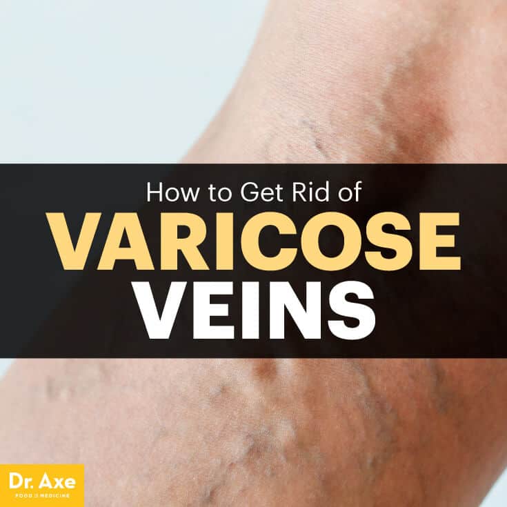 How to Get Rid of Varicose Veins 5 Natural Remedies Dr. Axe