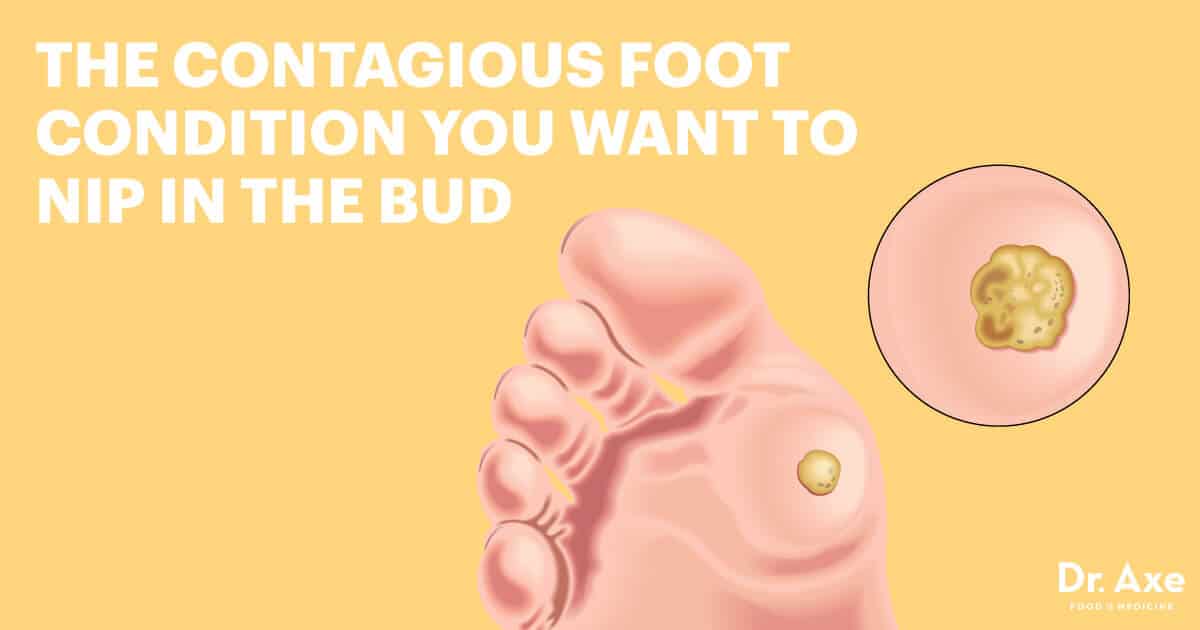 Planters Wart Removal Duct Tape Bruin Blog