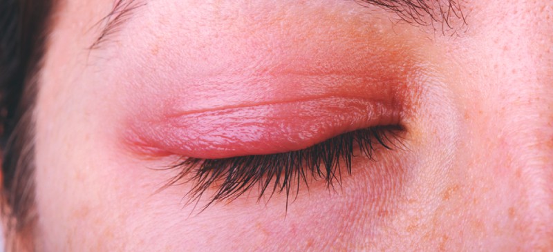 Blepharitis: 7 Natural Treatments To Soothe An Inflamed Eyelid - Dr. Axe