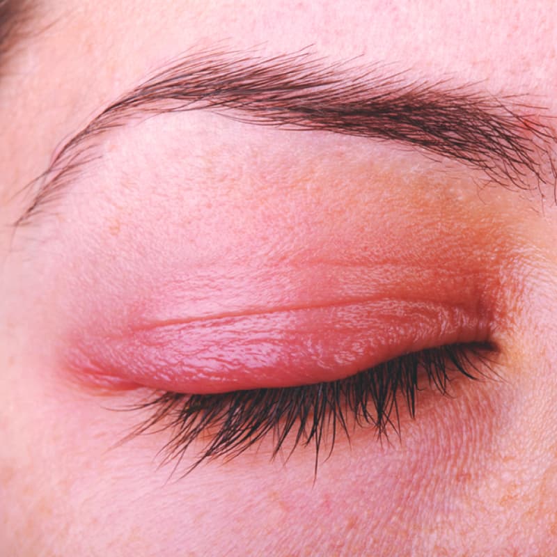 Blepharitis: 7 Natural Treatments To Soothe An Inflamed Eyelid - Dr. Axe