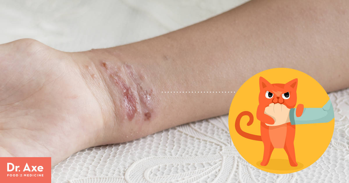 Cat Scratch Fever See Your Doctor + Find Natural Relief Dr. Axe
