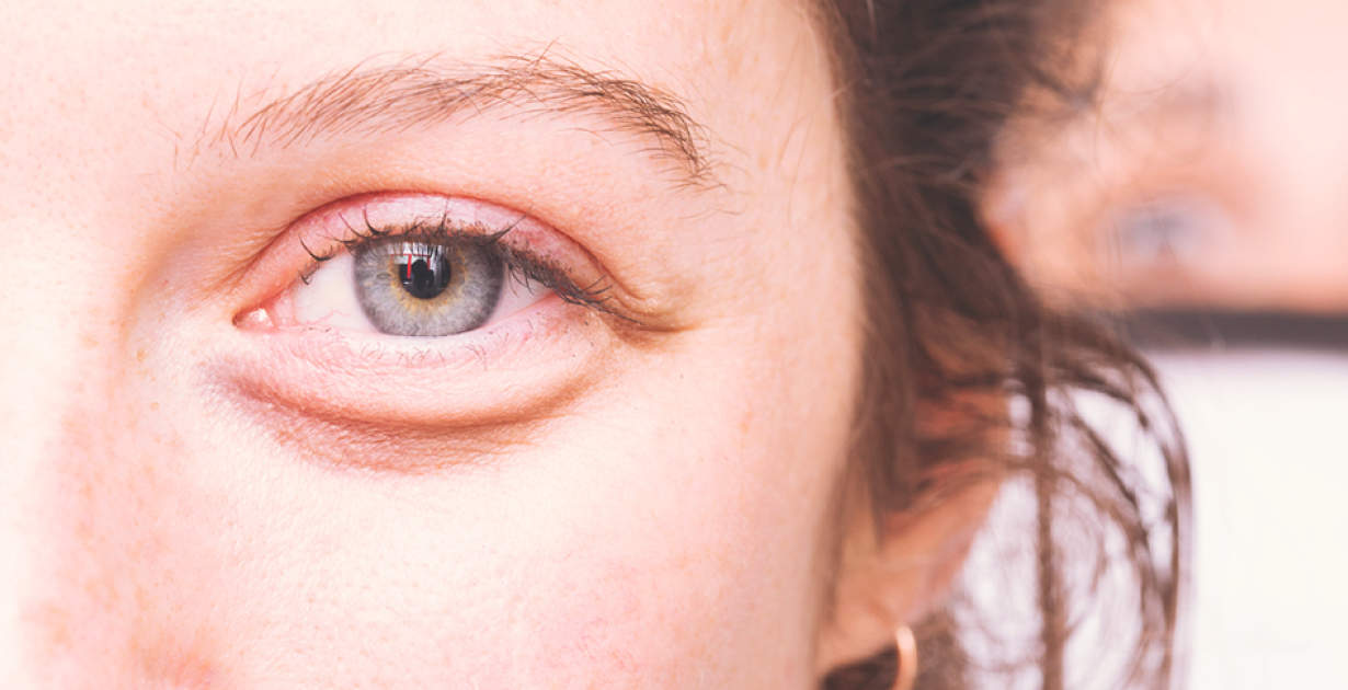 Sleep Deprivation Is Lack Of Good Sleep Turning You Into A Zombie