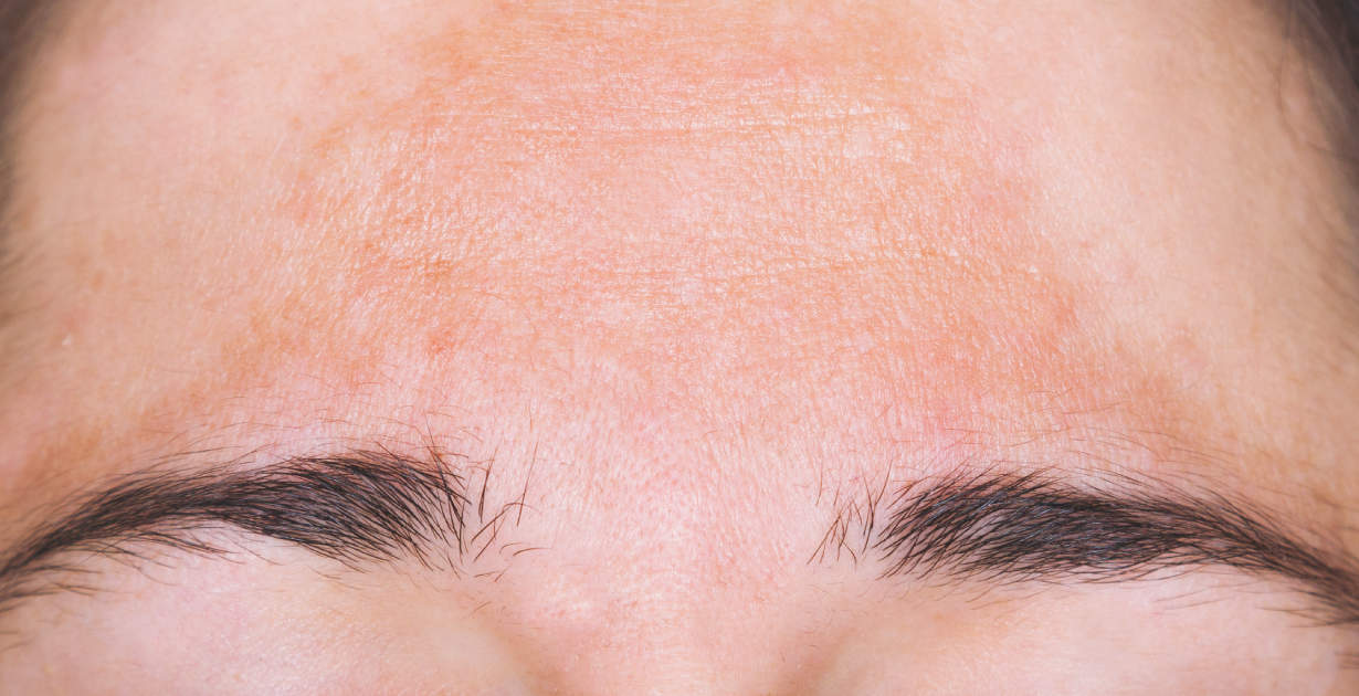 Chloasma (Melasma + How to Get Rid of Pregnancy Mask) Dr