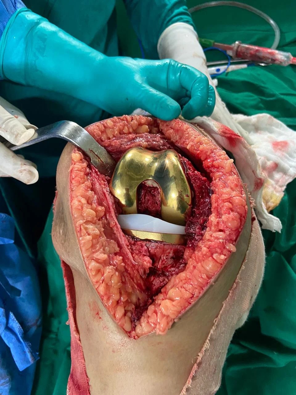 Guide to Choose the Right Knee Replacement Implant