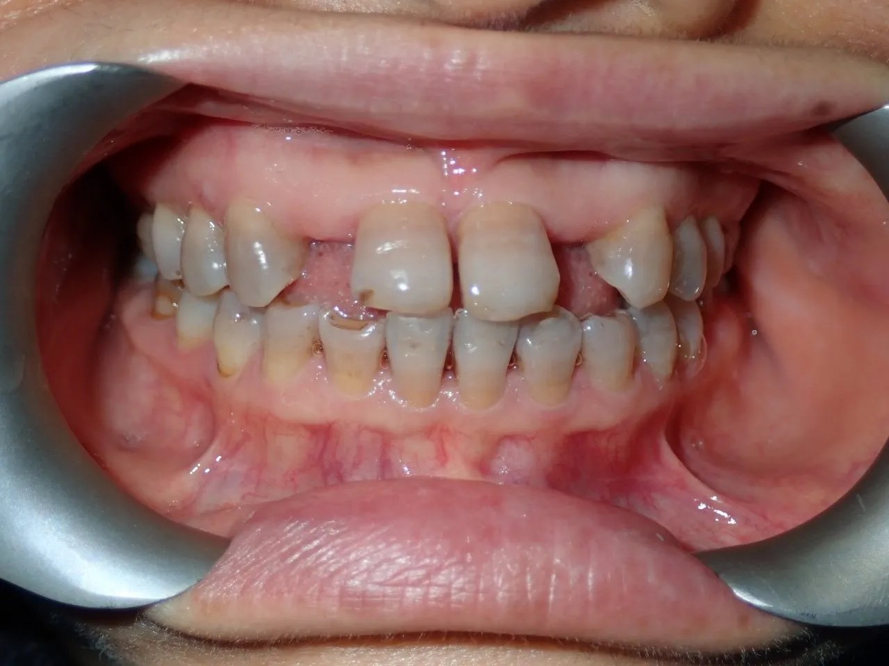 Preprosthetic Consideration for Adult Orthodontics Dr. Beatrice Leung