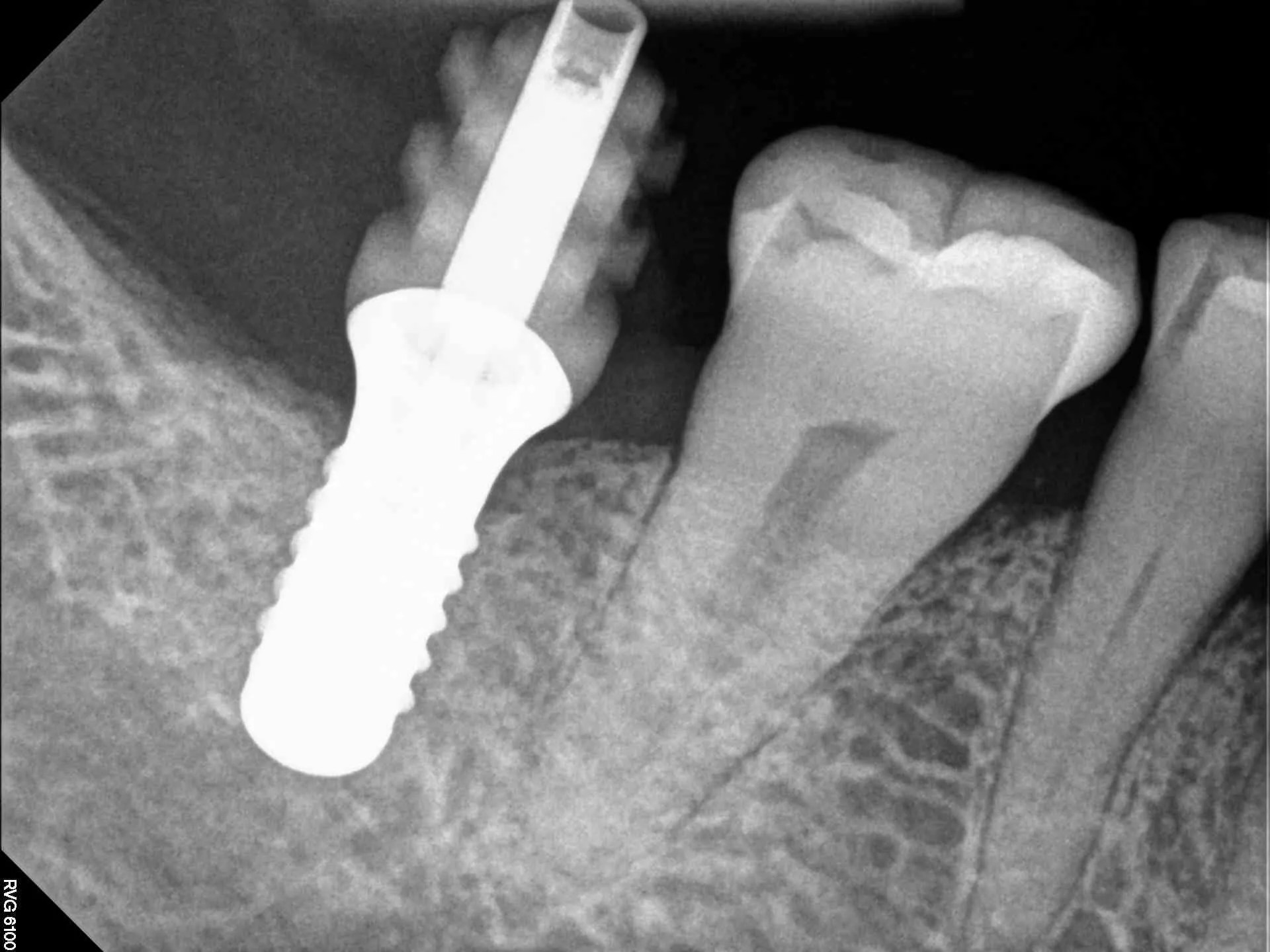 Cheek Biting After Posterior Teeth Replacement With Implants Dr