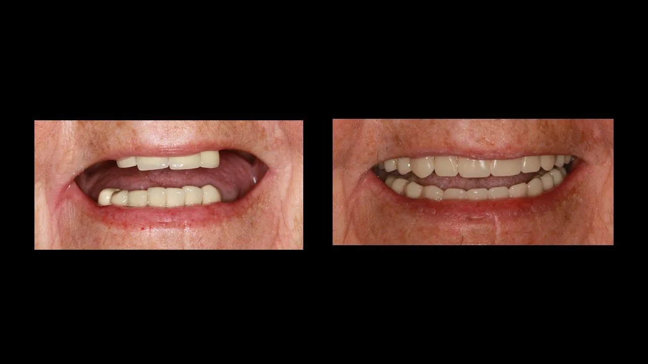 Patients with Terminal Dentition Dr. Beatrice Leung
