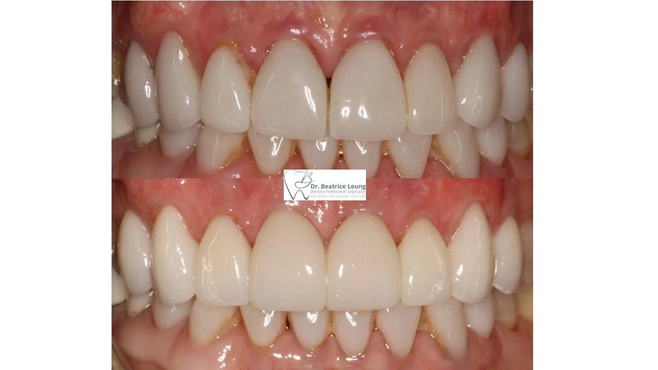 The Unaesthetic Black Triangle Dr. Beatrice Leung