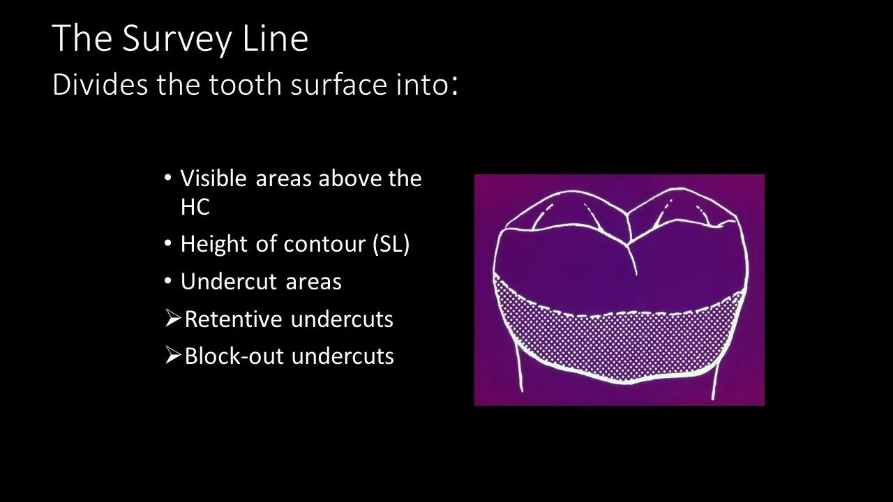 My Intraoral Surveyor Dr. Beatrice Leung