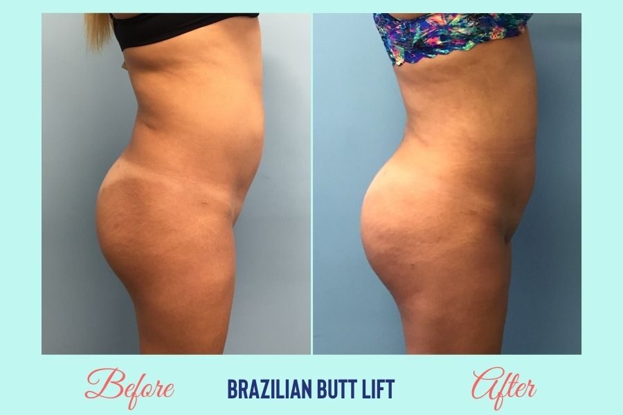 Brazilian Butt Lift Miami BBL Dr. Bernabe Vazquez