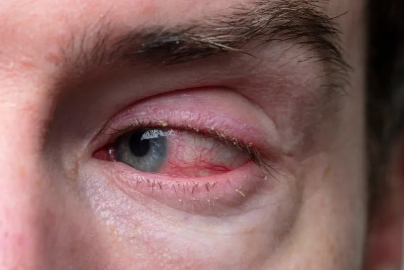 Blepharitis Thanos Bezatis