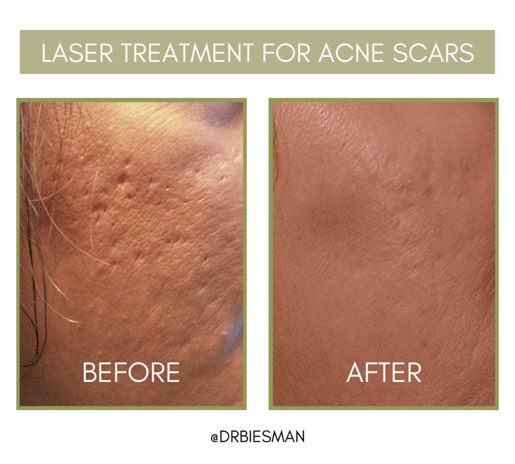 Acne Scarring Treatment Options Brian S. Biesman M.D.