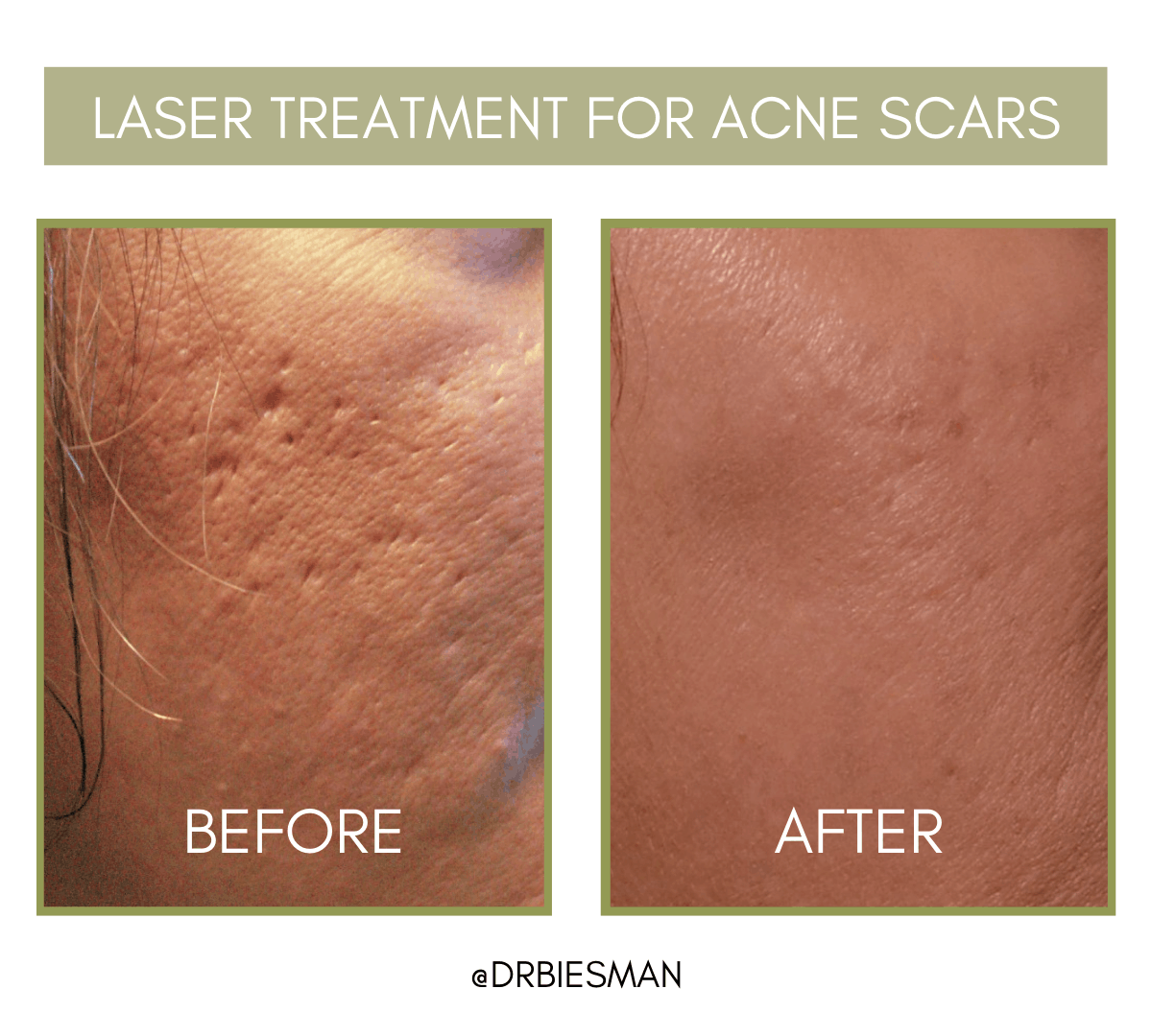 Acne Scarring Treatment Options Brian S. Biesman M.D.