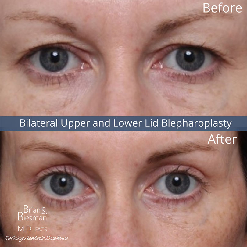 Upper and Lower Eyelid Surgery Nashville Blepharoplasty Nashville