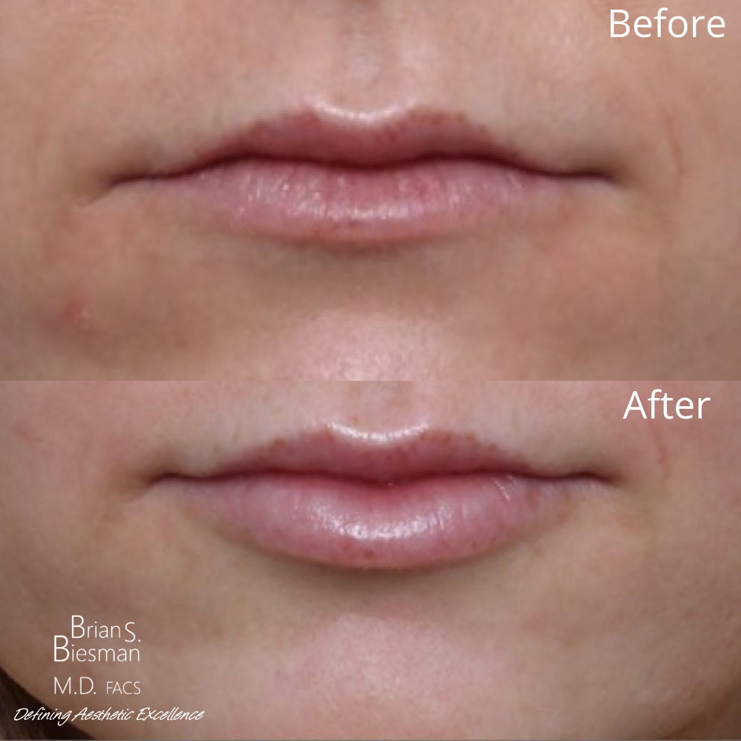 Lip Augmentation and Restoration Brian S. Biesman M.D.