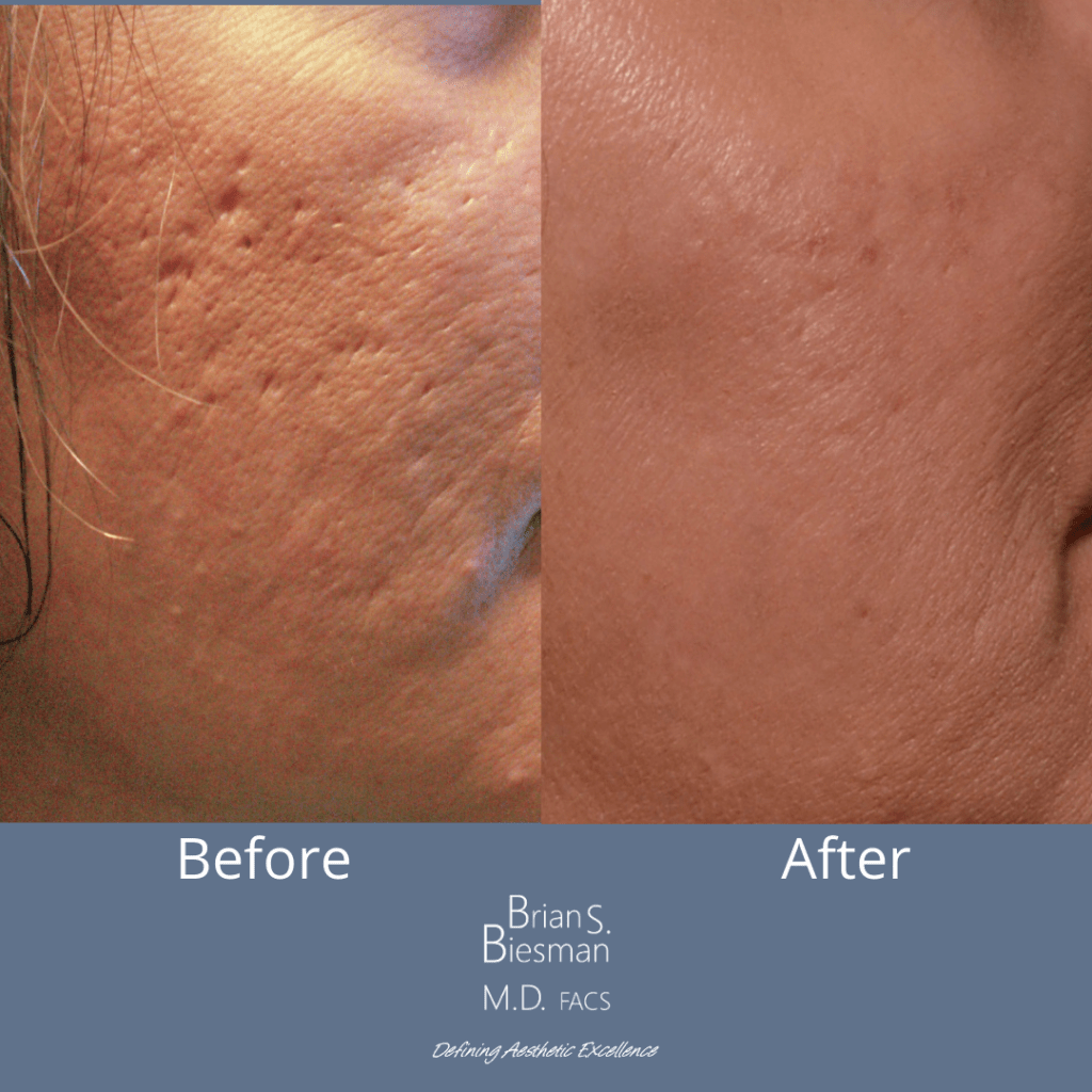 Scar Treatment Before and After Brian S. Biesman M.D.