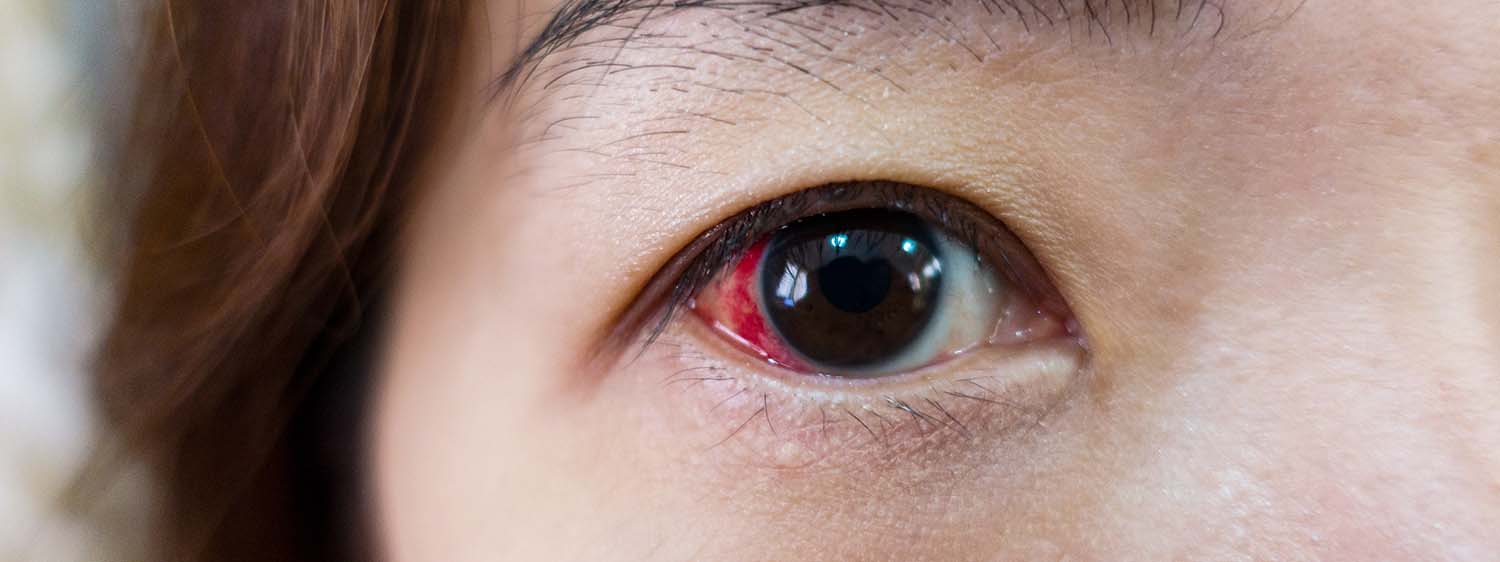 Common Eye Injuries Dr. Barry Leonard and Associates