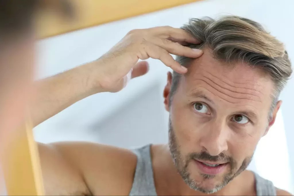 Male Pattern Baldness Causes of Hair Loss Dr Bonaros