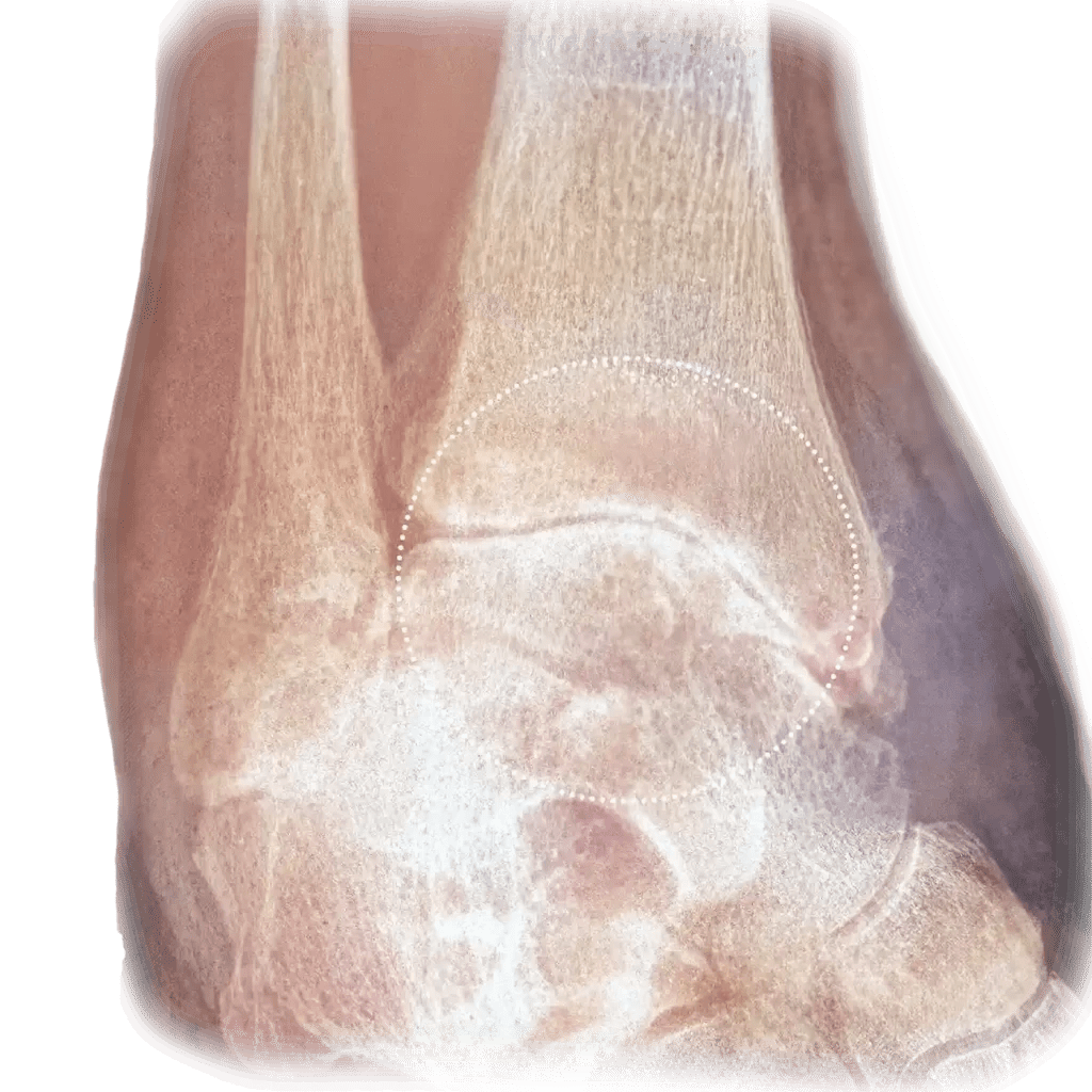 Ankle Arthritis Dr Bothma