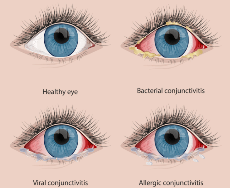 What Causes pink eye? Dr Bruce Coward Optometrists