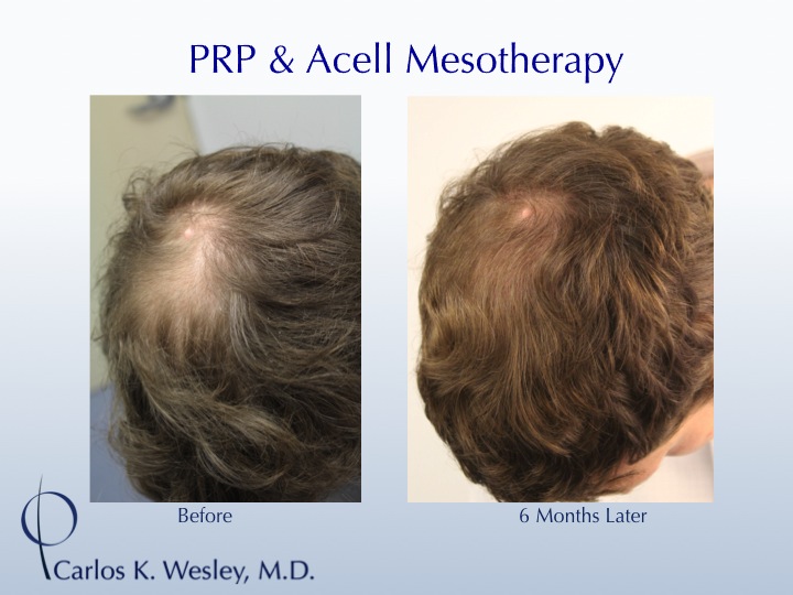 Dr. Carlos K. Wesley (NYC) PRP to a Man's Crown Hair loss Forum