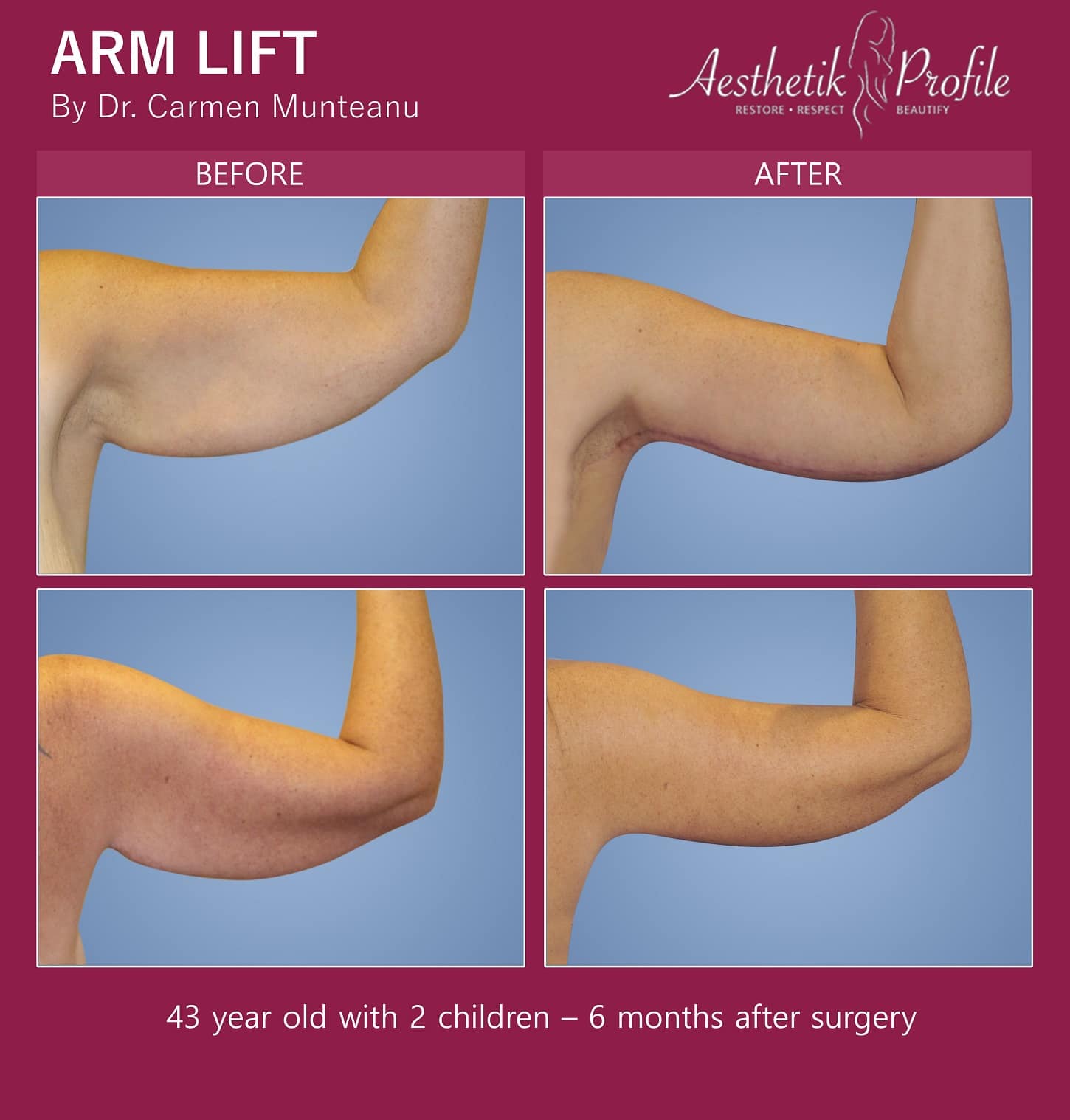 Arm lift Before and After Photos Dr Carmen Munteanu