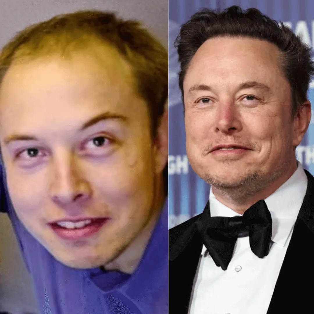 Natural vs. Surgical Male Celebs With Big Foreheads Dr. Cengizhan