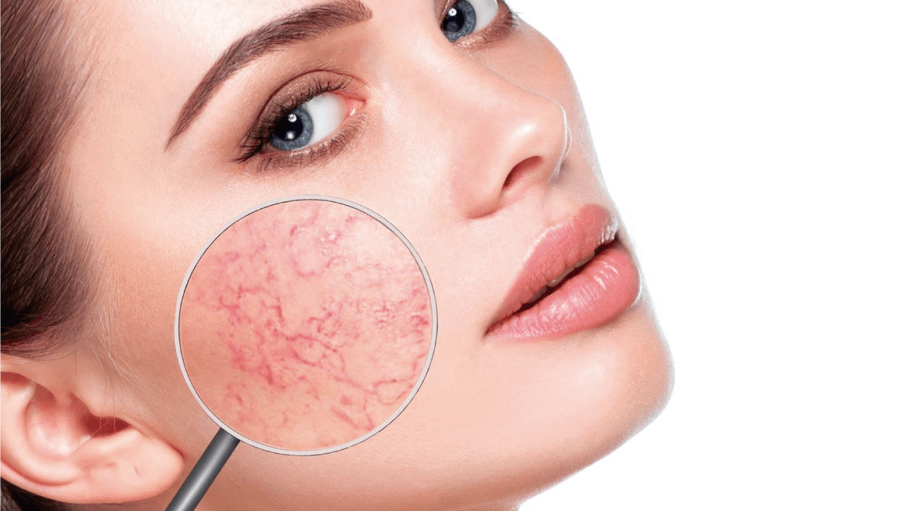 ¿Qué es la rosácea? Clínica Dermatológica y Estética Doctor César