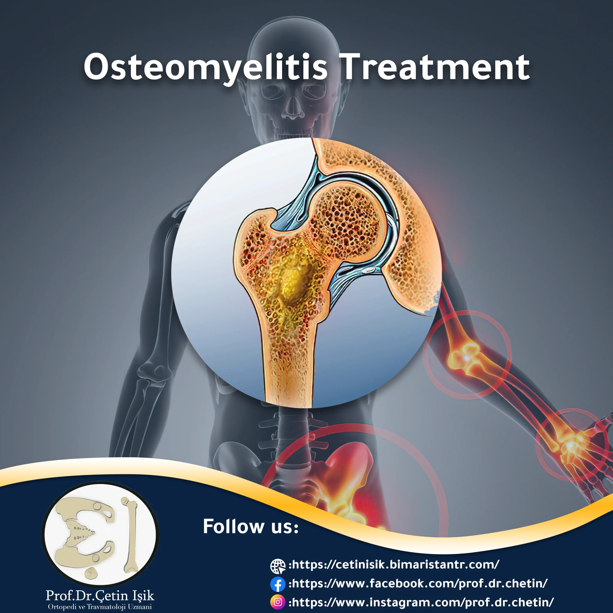 Treatment of osteomyelitis Dr. What's wrong with you?