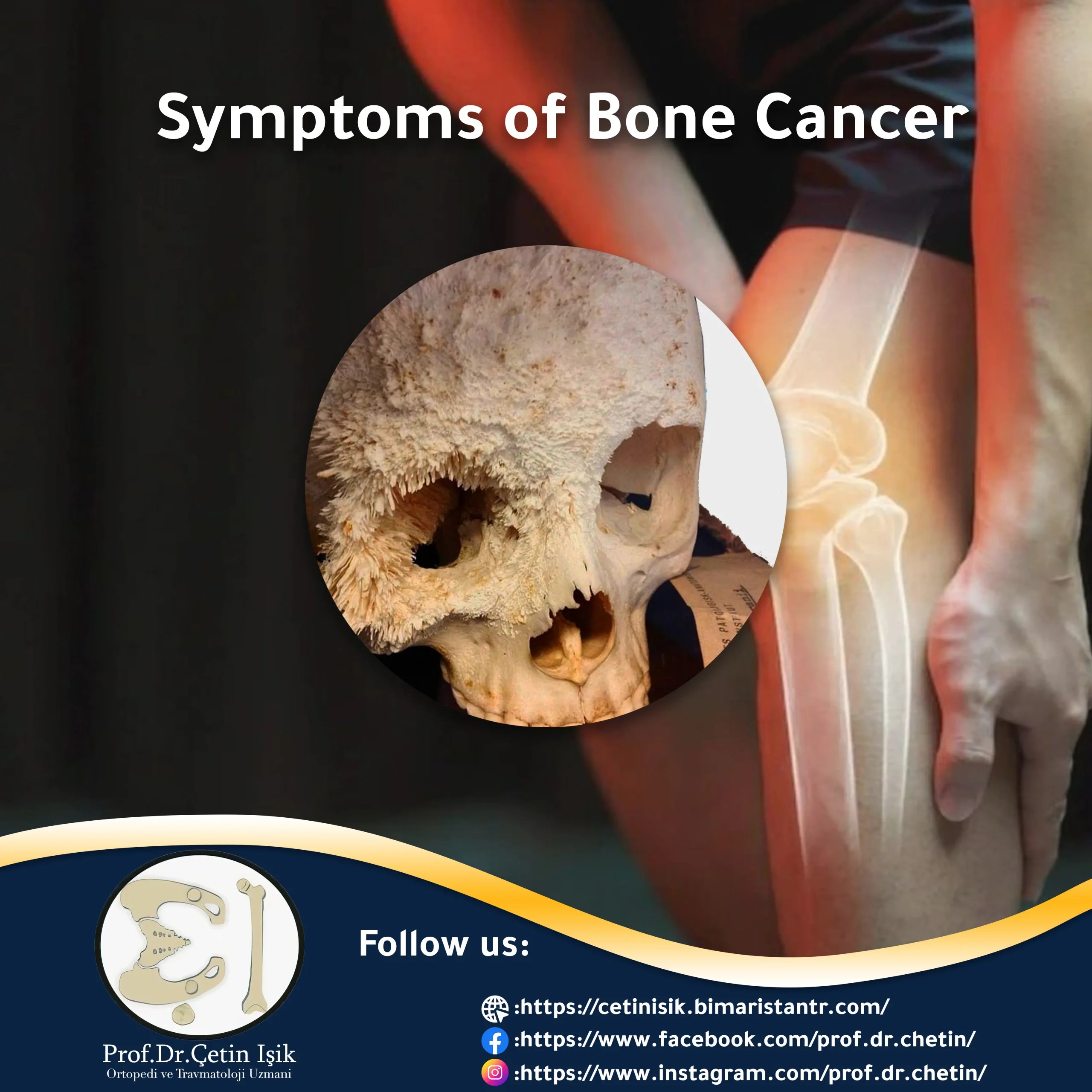 Symptoms of bone cancer Dr. What's wrong with you?