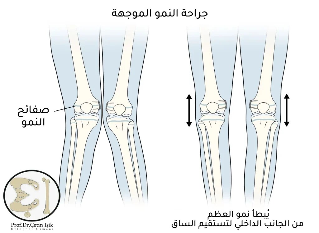 الركبة الروحاء؛ أبرز الأعراض وطرق العلاج د. شتين اشيك