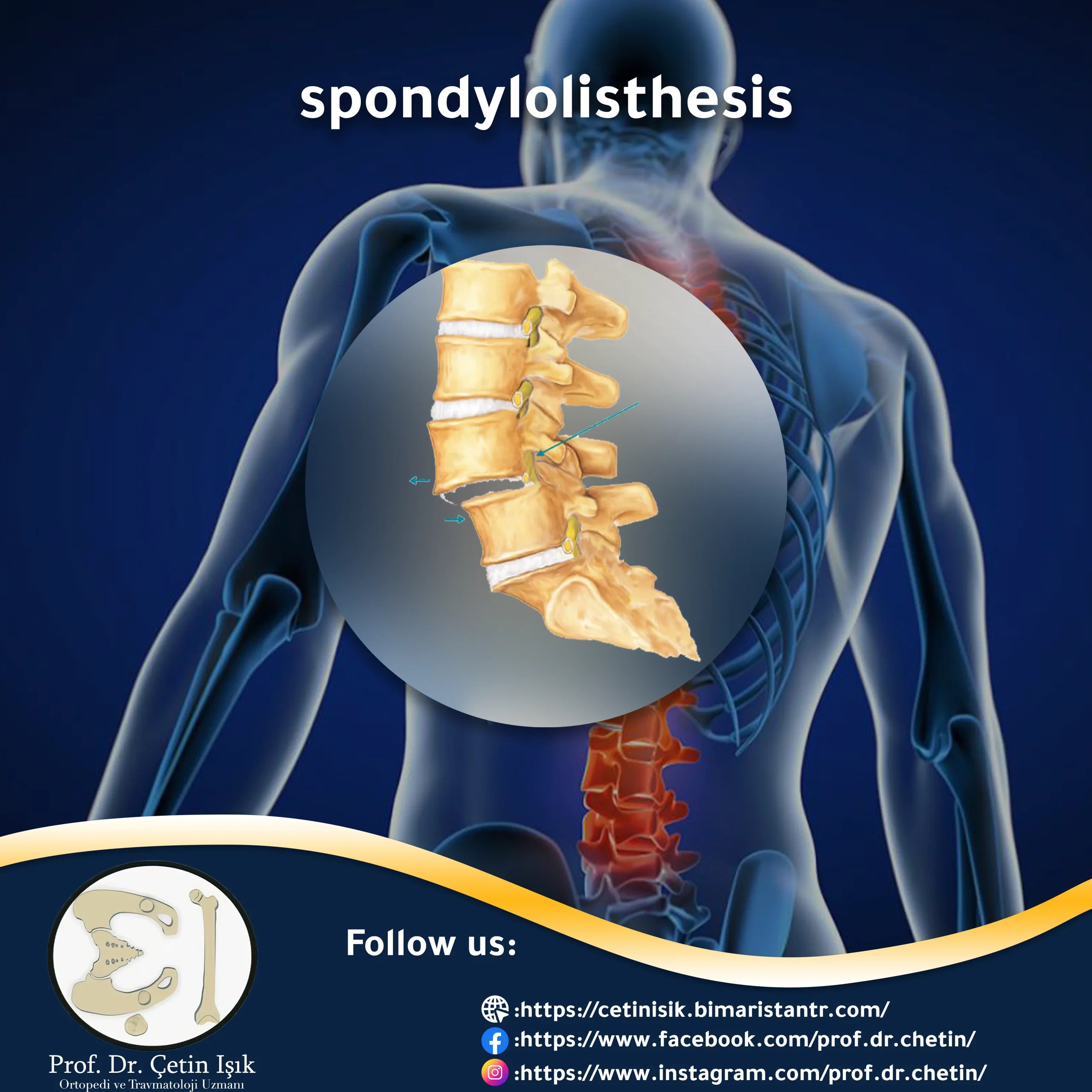 Slippage of the lumbar vertebrae of various types and degrees Dr