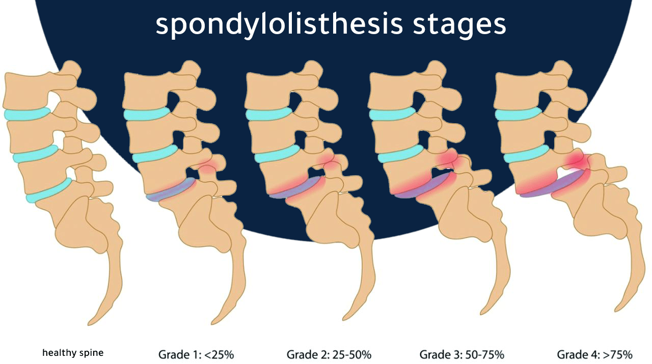 Slippage of the lumbar vertebrae of various types and degrees Dr