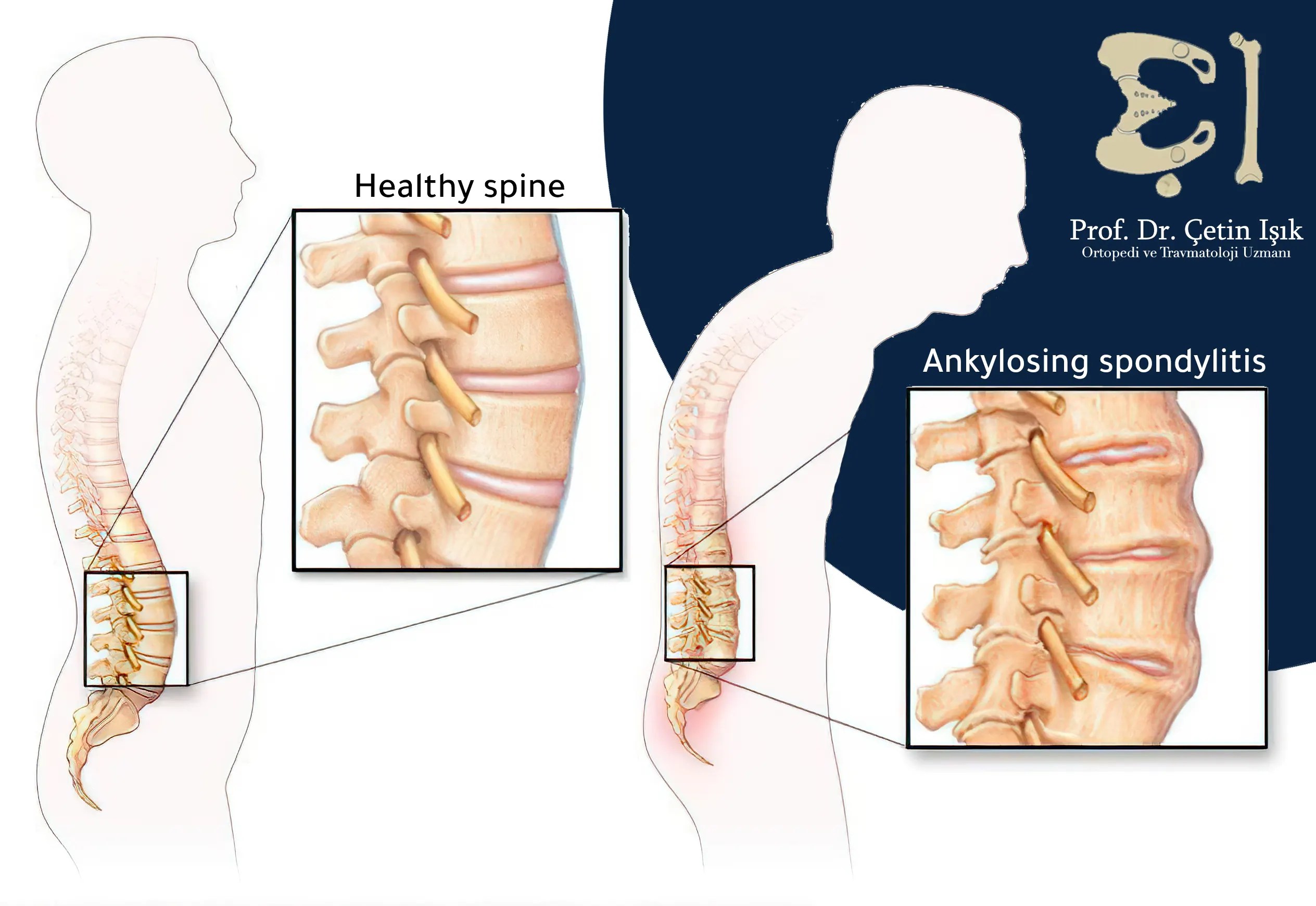 Everything related to ankylosing spondylosis Dr. What's wrong with you?