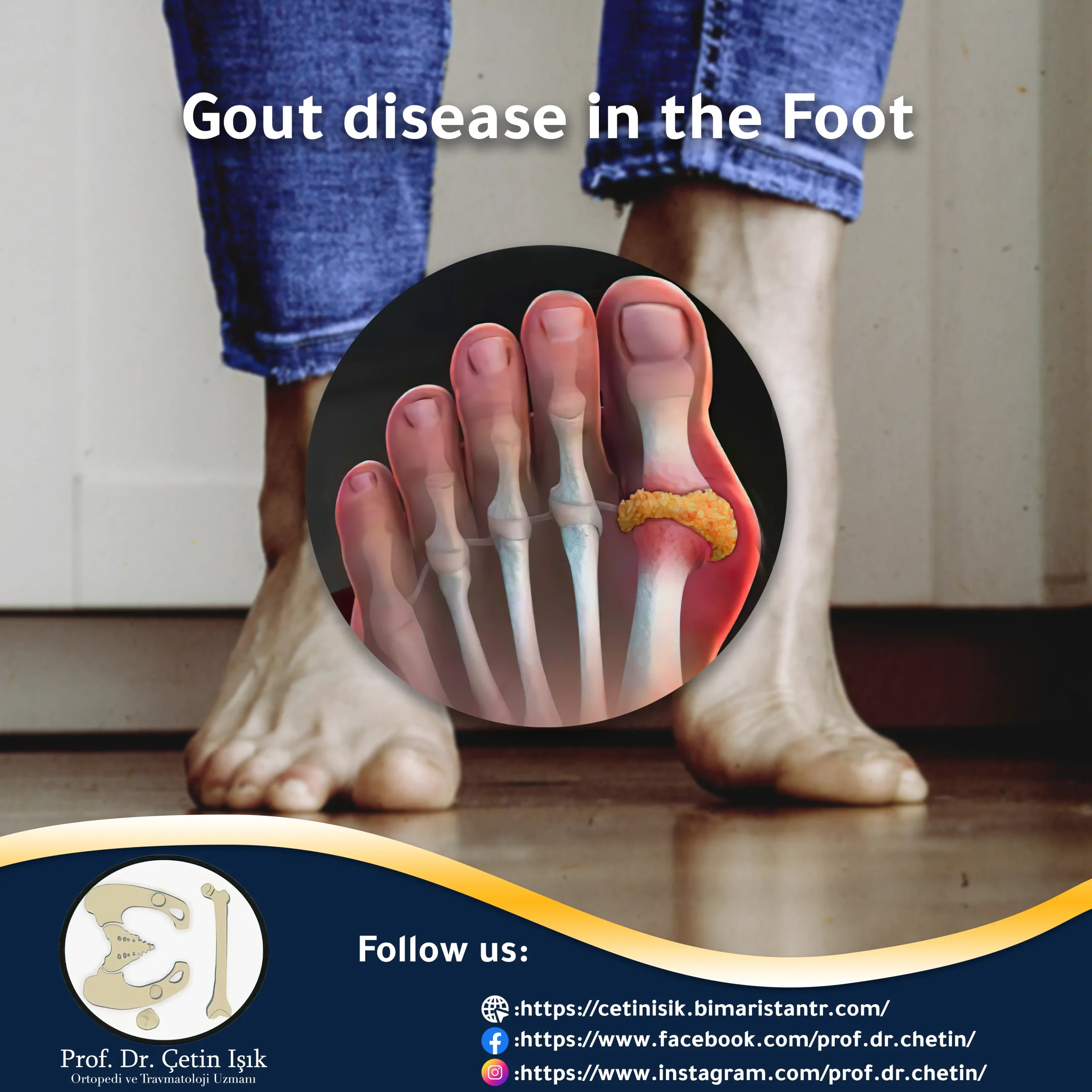 Everything you need to know about gout in the foot Dr. What's wrong