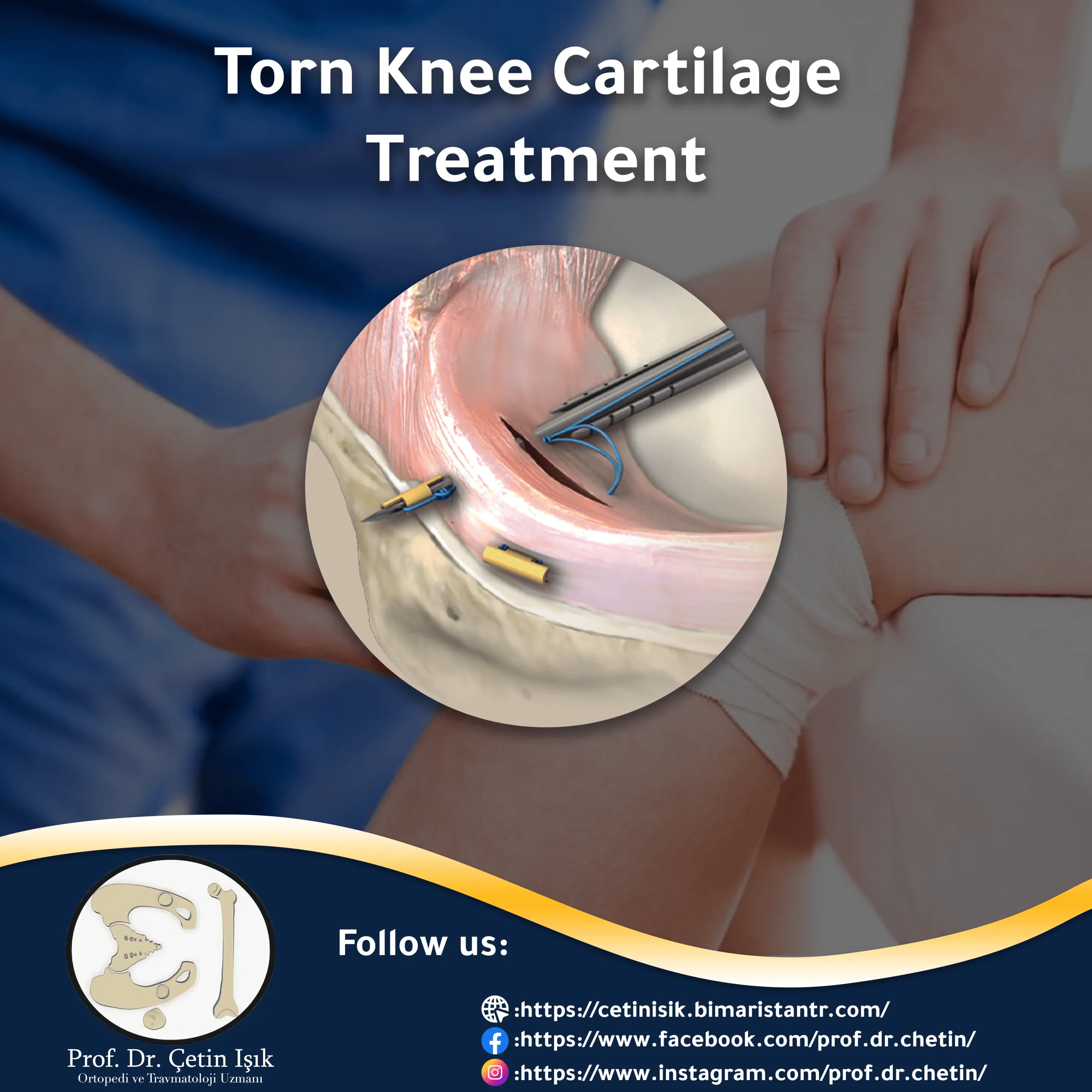 Meniscus tear treatment and best management options Dr. Cetin Isik