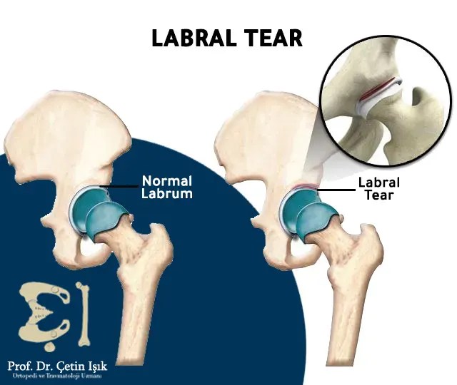 Hip labrum tear; Causes and treatment methods Dr. What's wrong with you?