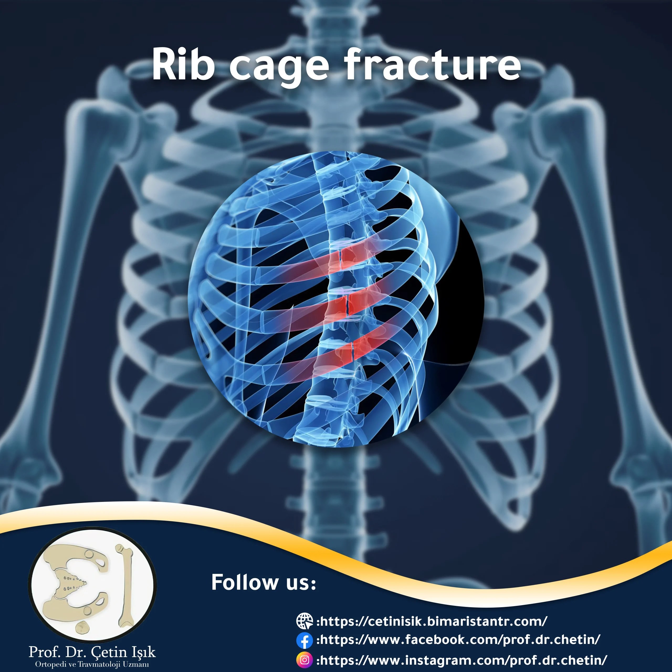 Fracture of the rib cage ways to treat it without surgery Dr. What