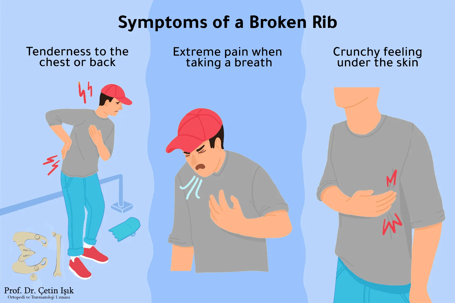 Fracture of the rib cage ways to treat it without surgery Dr. What