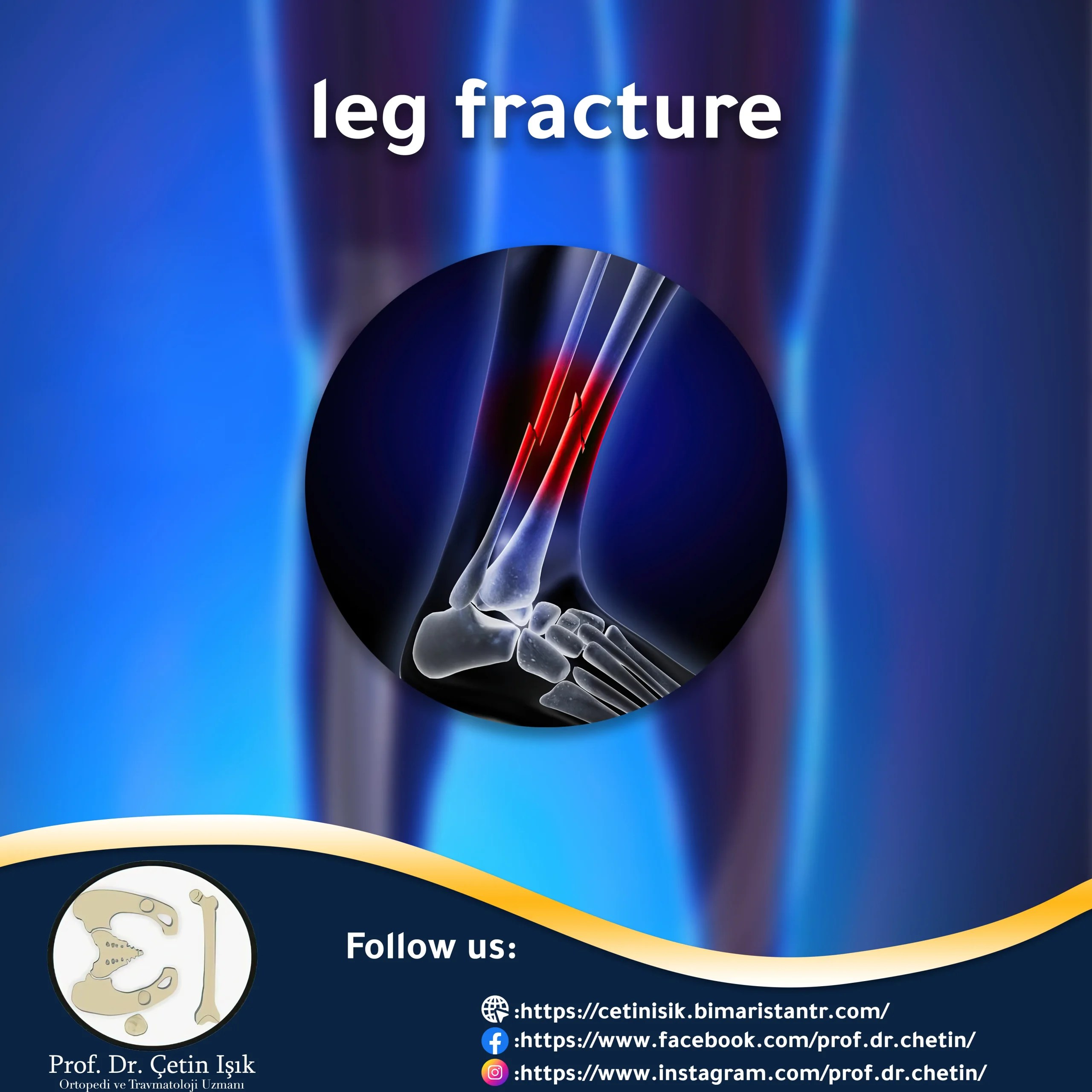 Leg fracture, how to determine its type and methods of treatment Dr